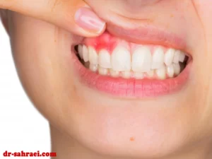جراحی لثه یا جراحی پریودنتال - دکتر وفااله صحرایی