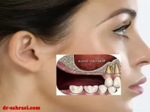 جراحی سینوس لیفت - دکتر وفااله صحرایی