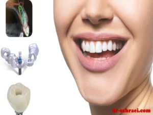 ایمپلنت دیجیتال - دکتر وفااله صحرایی