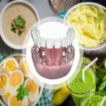 رژیم غذایی بعد از ایمپلنت دندان - دکتر وفااله صحرایی