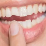 ترمیم دندان شکسته - دکتر وفااله صحرایی