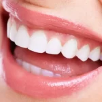 لیفت لثه برای کامپوزیت - دکتر وفااله صحرایی