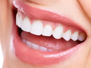 لیفت لثه برای کامپوزیت - دکتر وفااله صحرایی