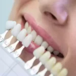 قیمت لمینت دندان - دکتر وفااله صحرایی