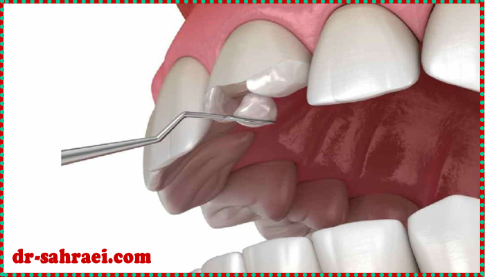 پیشگیری و کاهش عوارض کامپوزیت